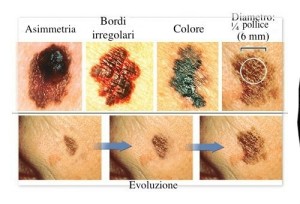 tumore pelle vari tipi